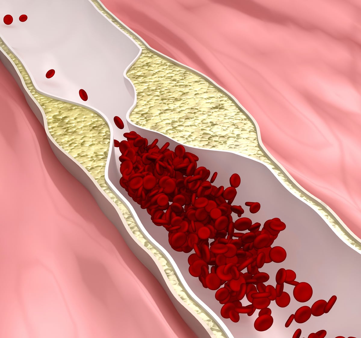 Q&amp;A: How Does Coronary Artery Disease Develop?